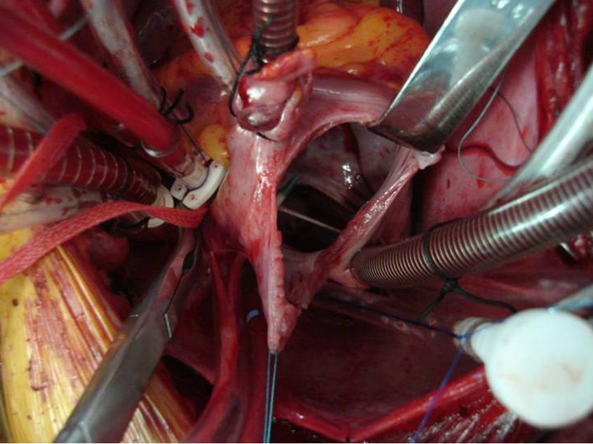 Cardioplegia 1. Stops the heart so that it remains still for surgery 2.