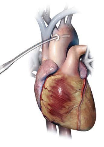 Cardiopulmonary Bypass Arterial