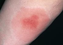 if allergic (wheezing, large areas of rash, hard to swallow), use EpiPen or 911