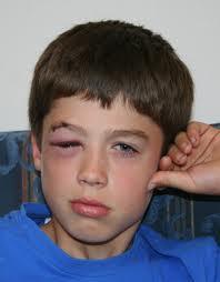 j) Eye injury, k) Knocked-out tooth Eye If any vision problem,