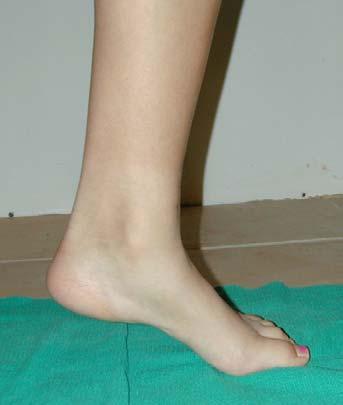 The First Metatarsal Rise Sign Hittermann first described this test for PTTD 11.