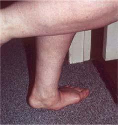 The examiner externally rotates the leg or inverts the heel of the affected foot.