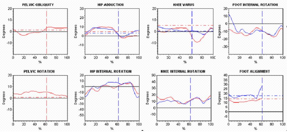Statistical Analysis of Gait Data to Assist Clinical Decision Making 63 infrared domain of the cameras.