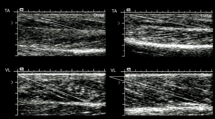 [ research report ] Journal of Orthopaedic & Sports Physical Therapy TA muscle, 25 therefore fascicle length was measured only in the superficial unipennate portion of the muscle.