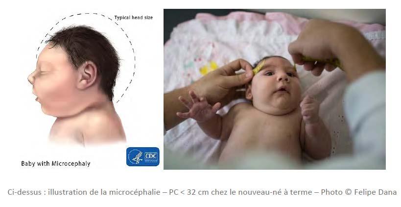 Microcephaly It is not yet conclusive that Zika transmits Microcephaly Above: