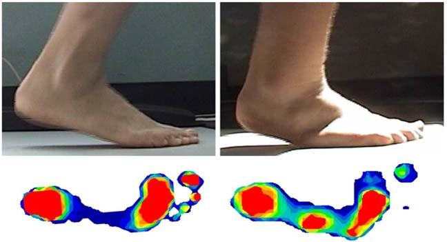 2 J.M. DESILVA ET AL. Fig. 1. Variation in midfoot mobility in humans.