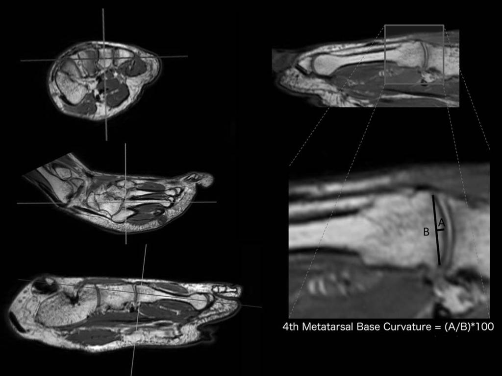 4 J.M. DESILVA ET AL. Fig. 2. 3D MPR of the foot (left).