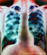 Respiratory Disorders Pulmonary Fibrosis - Pulmonary fibrosis = buildup of fibrous tissue in lungs stiffens them (restrictive disorder) MANY CAUSES > Breathing in