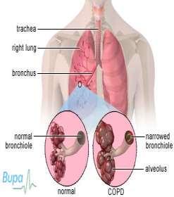 Respiratory Illnesses Chronic Obstructive Pulmonary Disease (COPD) Chronic