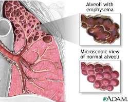 Respiratory Illnesses - Emphysema Chronic destruction of alveolar tissue (walls between