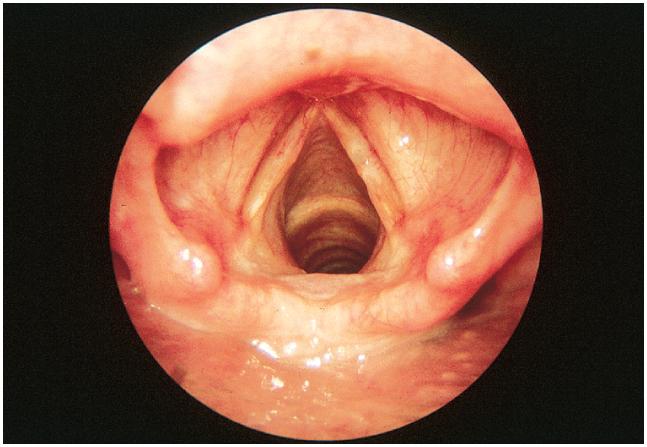 Endoscopic View of the Larynx Copyright The McGraw-Hill Companies, Inc.