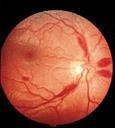 Misc. Neurologic Problems at Altitude Retinal micro hemorrhages. approach 100% at 8000m. Decreased night vision. Periodic breathing (Cheyne-Stokes).