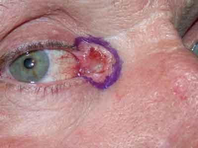 Physical Science - 2017 60 Infra-red waves Skin injury Skin injury from laser