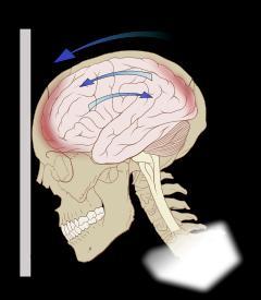 brain falls victim to a diffuse axonal injury (DAI).