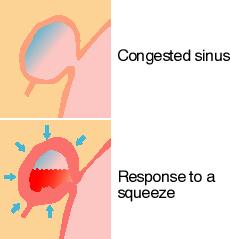 Sinuses Your sinuses are air cavities lined with mucous membranes and surrounded by the bones of your head.