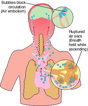 Lung over-expansion injuries Air embolism: The most serious injury.
