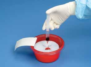 Non-Sterile Angiographic Accessories Splash Stop A safe alternative to messy, open basins Closed bowl minimizes staff and patient