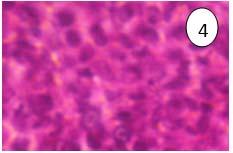 The CS cells are having vesicular nucleus with nucleoli clearly visible.