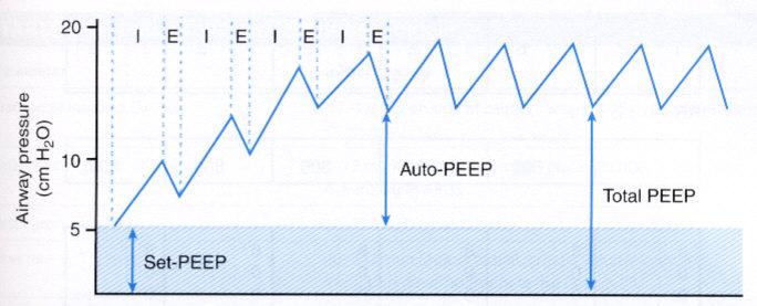 AUTO PEEP All lungs have a low amount of auto-peep which rises in disease states like asthma