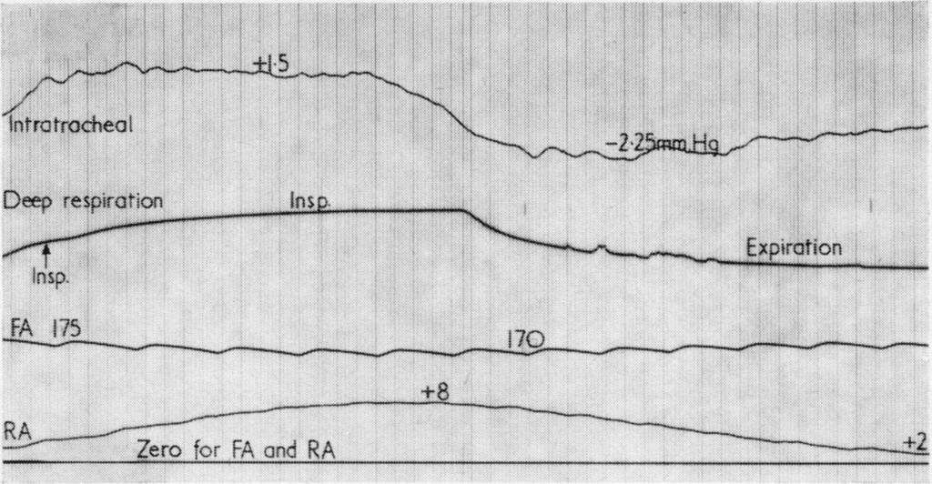 :~~~~~ Effect of respiratory obstruction on the arterial and venous circulation in animals and man 7 B A/" Sp, Deep respiration -FA -175 17 Zero fr FA Ins nd RA +8 FIG. 8.
