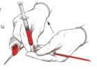 10. Withdraw volume of blood required into syringe slowly. Allow a little more than required. 11.