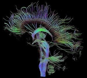 DTI (Tractography) Diffusion Tensor Imaging (DTI) is a technique that detects the directional diffusion in tissues.