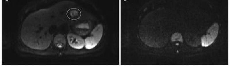 DWI Lesion characterization Benign lesions as simple cysts and hemangiomas show high ADC