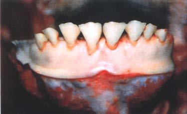 Figure 3 Eruption status of incisor A Deciduous B - Missing C P. Erupting D P.