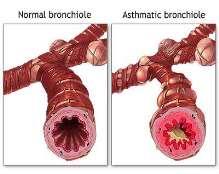 Obstructive Pulmonary Disease (COPD) = chronic bronchiole inflammation (bronchitis) - Leads to bronchiole scar-tissue (fibrosis ), which narrows bronchioles (bronchoconstriction) - mucus buildup