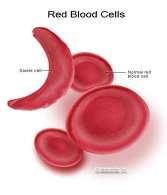 - Hemoglobin-S turns RBCs into sickle-shape.