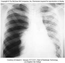 Clinical App Pg. 539 Pneumothorax in R lung pneumothorax = a chest wound ( traumatic pneumothorax ) causes air from inside the lungs enters intrapleural space.