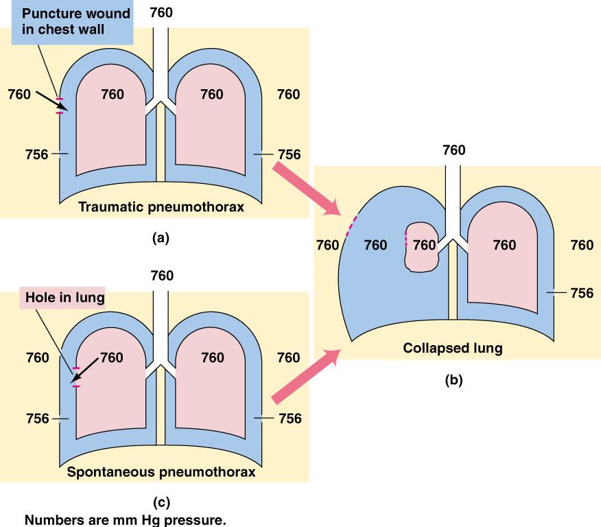 Intrapleural Pressure and Pneumothorax Intrapleural pressure maintains the alveoli