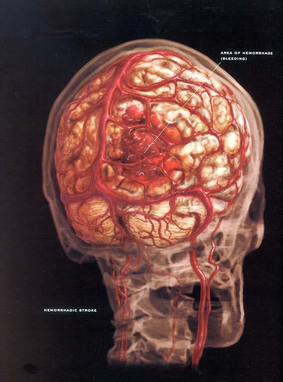 vessels in the brain