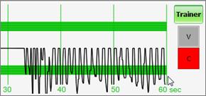 PERFORMANCE EXAMPLES Compressions are too shallow. Most waveform peaks do not reach the green zone. Compression indicator is yellow.