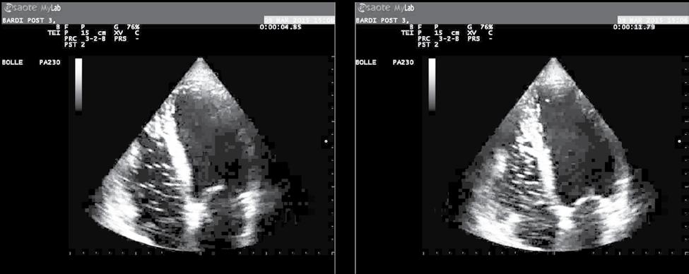 Figure 1: Case of high-grade bubbles after repetitive breath-hold dives. Left: bubbles at rest. Right: bubbles after standard exercise (leg bending).