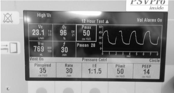 weight Respiratory Rate Set for a reasonable MV - but not > 35 ARDSnet Goals Plateau Pressure vs Peak