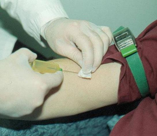 Figure 5-XXI: Remove Needle Slowly Failure to remove the tourniquet prior to removal of the needle may result in a haematoma. 12.