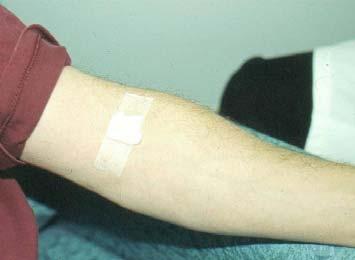 Check the patient s arm to ensure bleeding has stopped and apply bandage or tape over folded square of gauze.