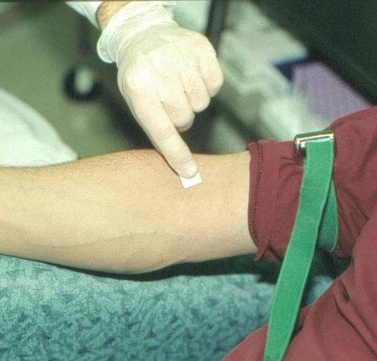 Figure 5-VI: Release the Tourniquet 5.5 Cleanse the venipuncture site Cleanse the venipuncture site with alcohol prep pad or other appropriate antiseptic such as 70% isopropyl alcohol solution or 0.