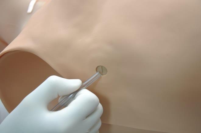 REPLACING NEEDLE DECOMPRESSION INSERTS The needle decompression sites accommodate several puncture exercises.