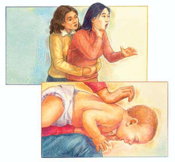 Use abdominal thrusts on a choking adult, but never on a choking infant. Use back blows alternating with chest thrusts for an infant.
