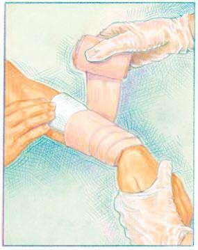 Secure the roller bandage over the dressing. Using overlapping turns, cover the dressing completely, as shown in the diagram at the left.
