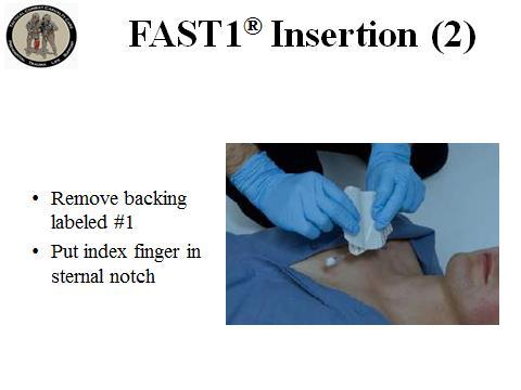 250 ml/min using syringe forced infusion 47. FAST1 Insertion (1) 1.Prepare site using aseptic technique: Betadine Alcohol Show them where the suprasternal notch is on yourself.