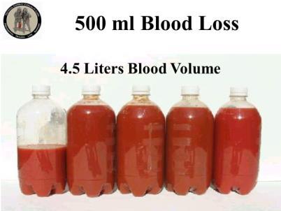INSTRUCTOR GUIDE FOR TACTICAL FIELD CARE #2 IN TCCC-MP 1708 32 83. 500 ml Blood Loss 4.5 Liters Blood Volume So here we have lost the first 500 ml of blood.