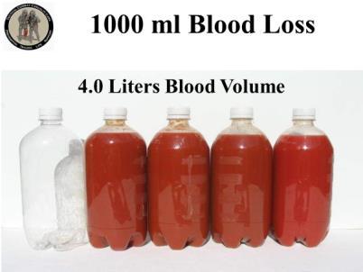 500 ml Blood Loss Mental State: Alert Radial Pulse: Full Heart Rate: Normal or slightly increased Systolic Blood pressure: Normal Respiratory Rate: Normal Is the casualty going to die from this?