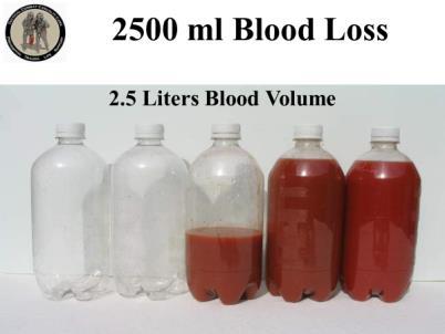 INSTRUCTOR GUIDE FOR TACTICAL FIELD CARE #2 IN TCCC-MP 1708 35 2000 ml Blood Loss 90.