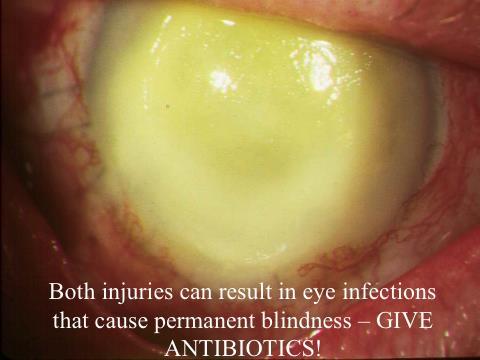Eye contents can leak out if you have an injury like this and bacteria can get into the eye and cause an infection.
