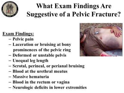 INSTRUCTOR GUIDE FOR TACTICAL FIELD CARE #2 IN TCCC-MP 1708 5 11. What Exam Findings Are Suggestive of a Pelvic Fracture?
