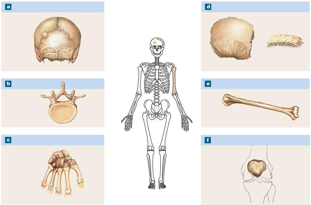 Sutural Bones Flat Bones Sutural bone Sutures Parietal bone External table Internal table Diploë