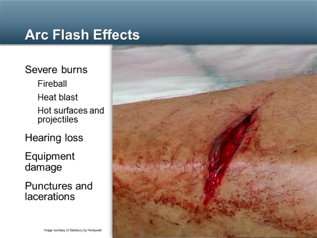 Electrical burns, often severe, are a common injury from arc flash incidents.